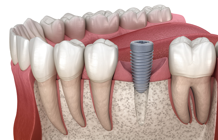 インプラント体の埋入