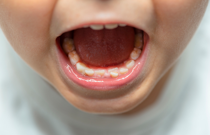 歯並びへの影響