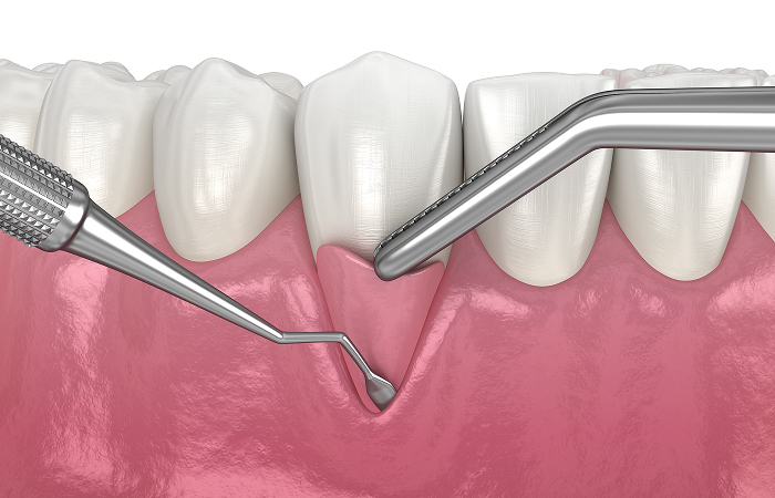 進行した歯周病の治療